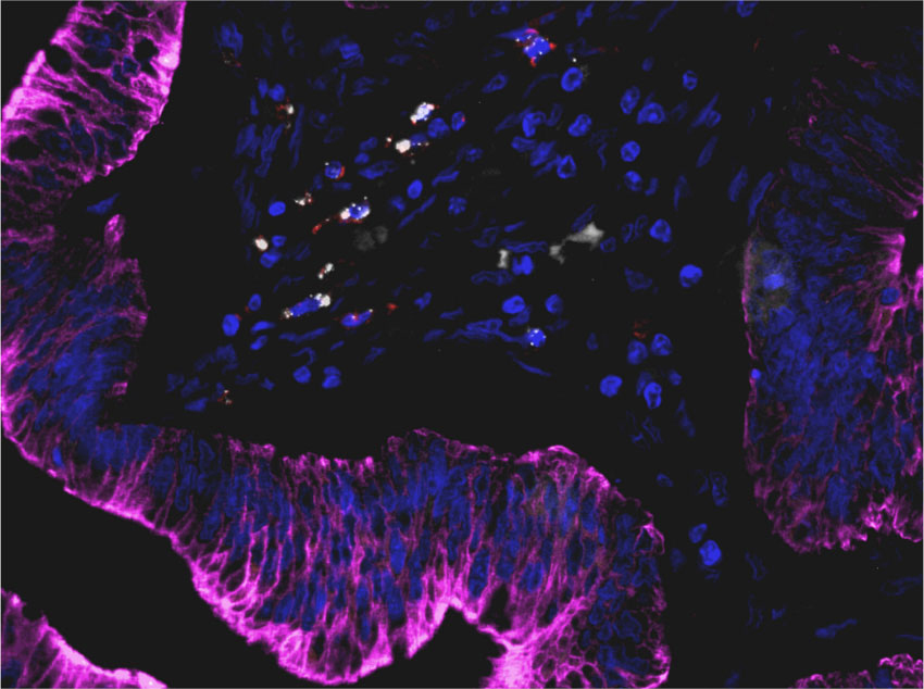 Tumeur et infiltration lymphocytaire